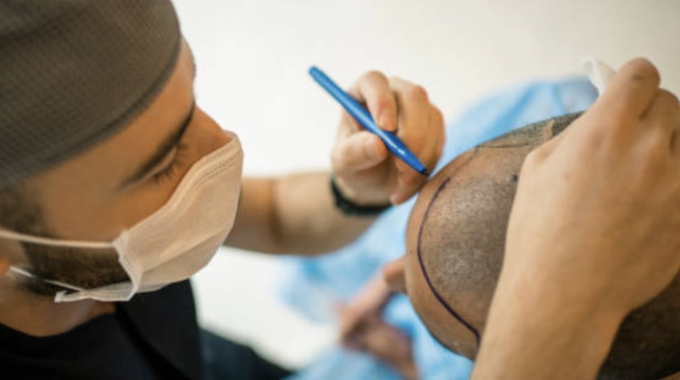 Preparing for Hair Transplant